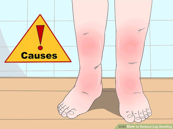 Swelling in Ankles & Feet
